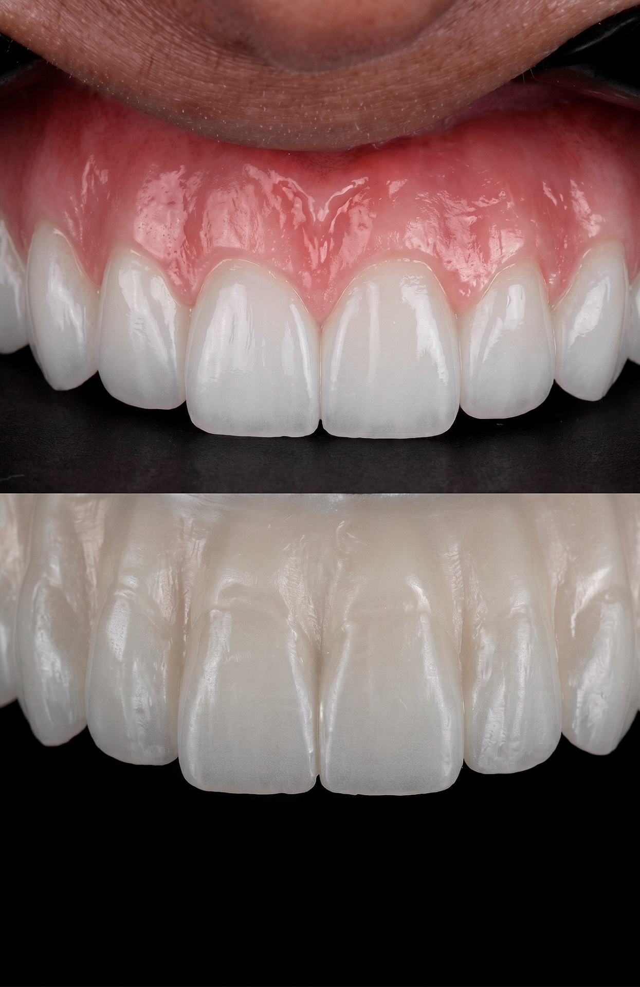 Prótese dentária premium em cerâmica estratificada